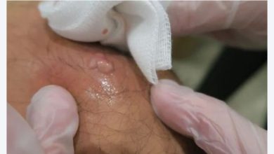 Photo of 粉瘤忍不住就想挤？ 医生警告：恐导致发炎