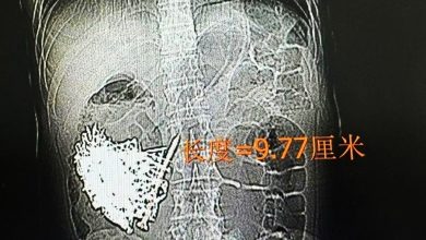 Photo of 胃里塞满181颗铁钉 男子手术取出近1公斤异物