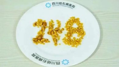 Photo of 三餐吃高油脂外卖 26岁男子胆囊取出248颗结石
