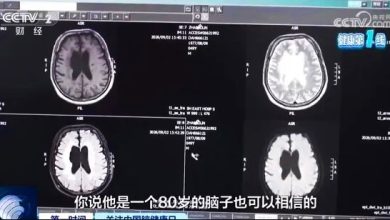 Photo of 熬夜滑手机突中风 49岁男大脑萎缩如80岁