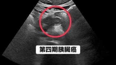Photo of 血糖突失控随后上腹不适  男子确诊胰脏癌第4期