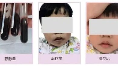 Photo of 长期吃隔夜菜 3岁男童脸色发紫