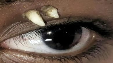 Photo of 少年眼睑冒出2白色尖物　医生一拔竟是牙齿